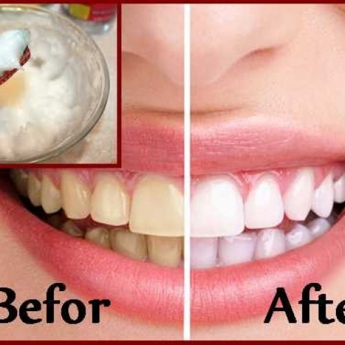 9 Natuurlijke manieren om je tanden te bleken die perfect werken.