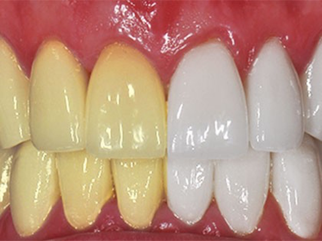 9 Tips om je tanden op een natuurlijk manier witter te | Naturotheek