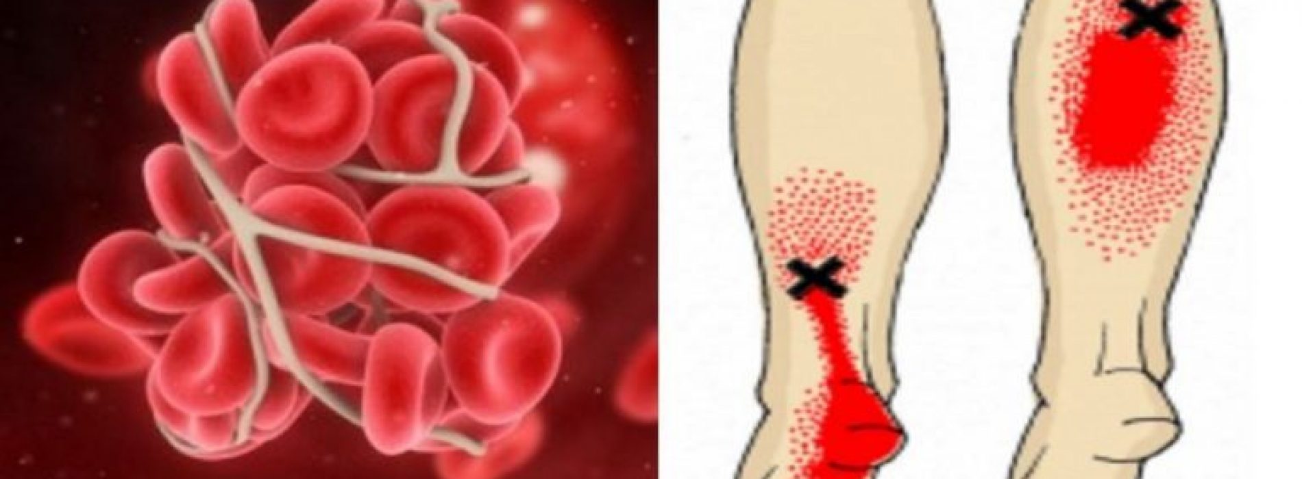8 makkelijk-te-missen tekenen die je kunnen waarschuwen voor een bloedprop/trombose