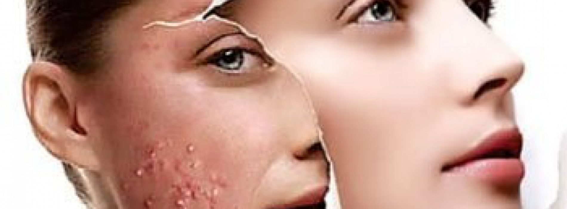 Hoe verhelp je Acne, eczeem en andere huidproblemen op een natuurlijke wijze