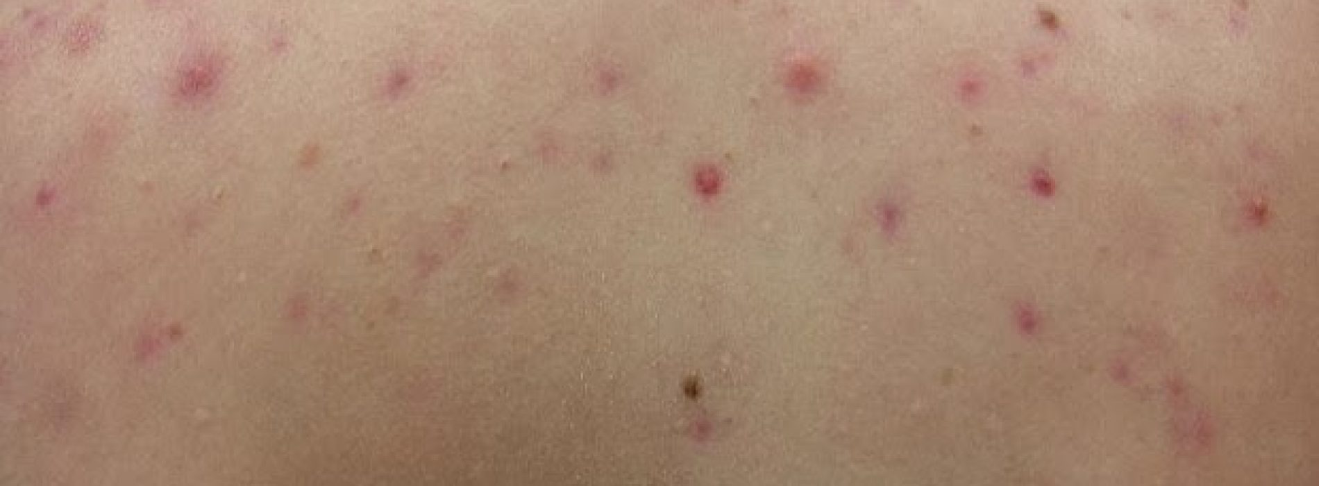 Last van acne op je rug? Waarschijnlijk doe je DIT helemaal verkeerd!