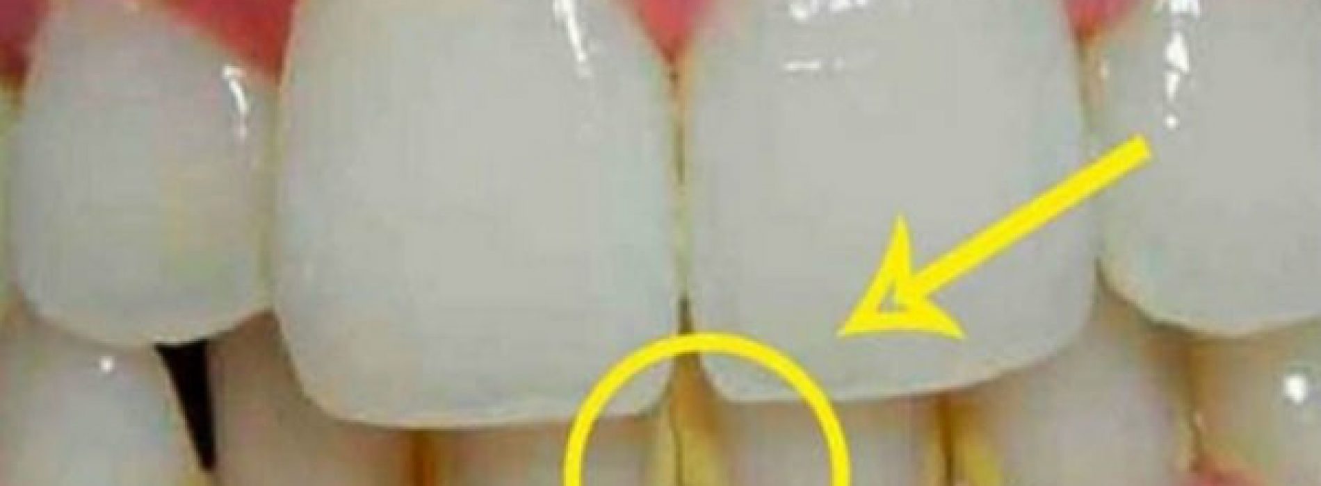 Hoe tandplak te verwijderen in 5 minuten op natuurlijke wijze, zonder naar de tandarts te gaan!
