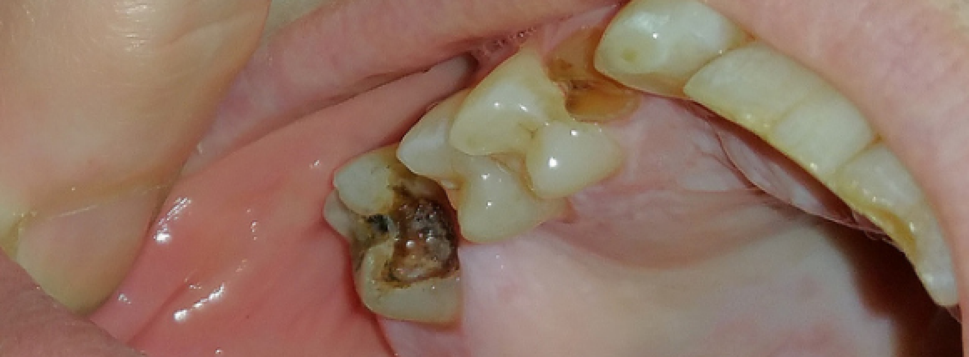 Met dit wijdverspreide geneesmiddel kunnen beschadigde tanden zich in de toekomst gewoon zelf herstellen. Dit is fantastisch!