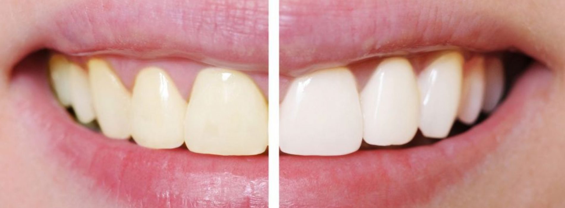 Zo krijg je hagelwitte tanden zonder je tanden te bleken! Dit is zo simpel!