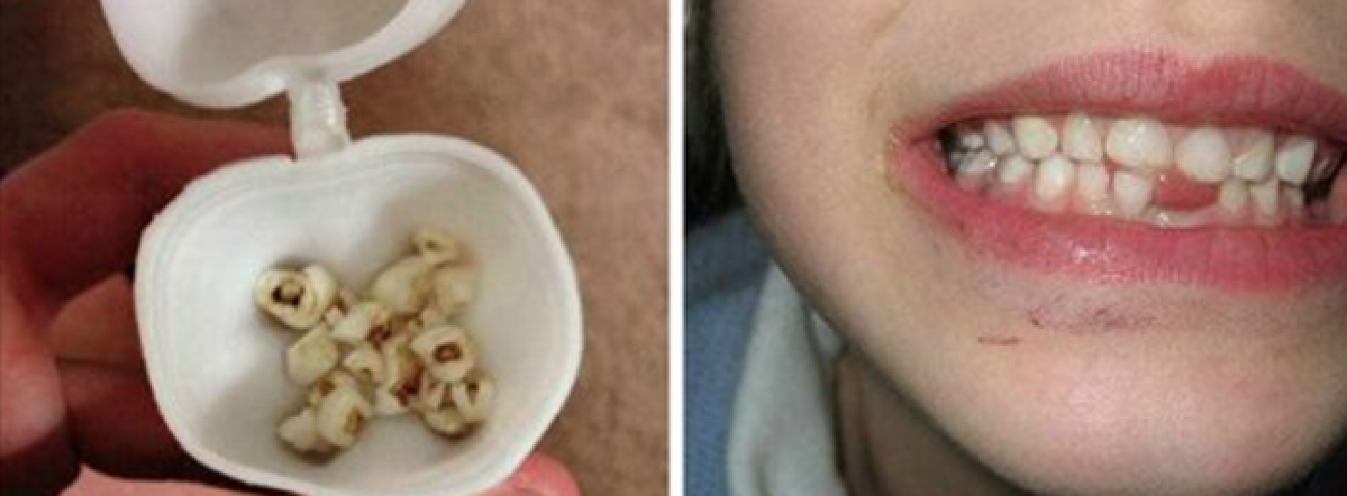 Onderzoekers dringen aan: gooi de melktanden van je kind niet weg! Ze kunnen levens redden!