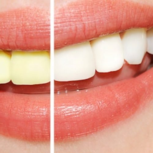 Een stralende witte lach zonder je tanden te bleken? Met DEZE tips gaat dat lukken!