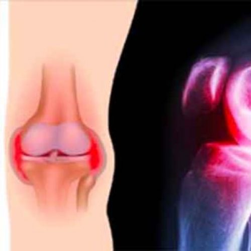 3 eenvoudige oefeningen die pijn in de knieën herstellen zonder chirurgie of medicatie