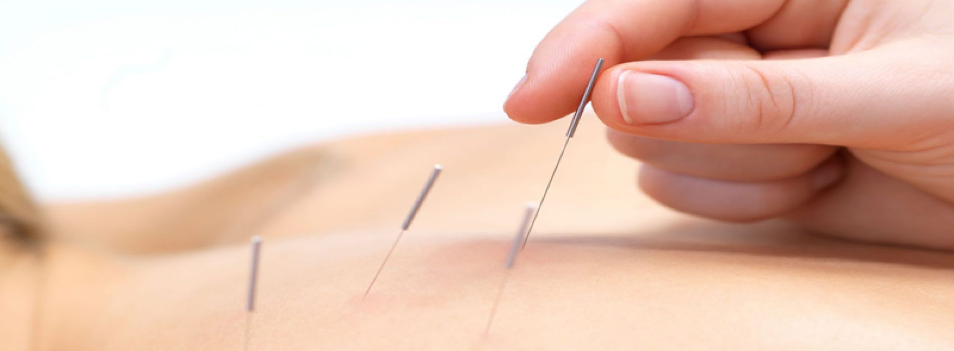 Heeft u voordat u naar pijnmedicatie grijpt al eens nagedacht over acupunctuur?
