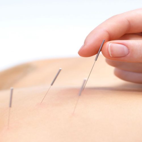 Heeft u voordat u naar pijnmedicatie grijpt al eens nagedacht over acupunctuur?