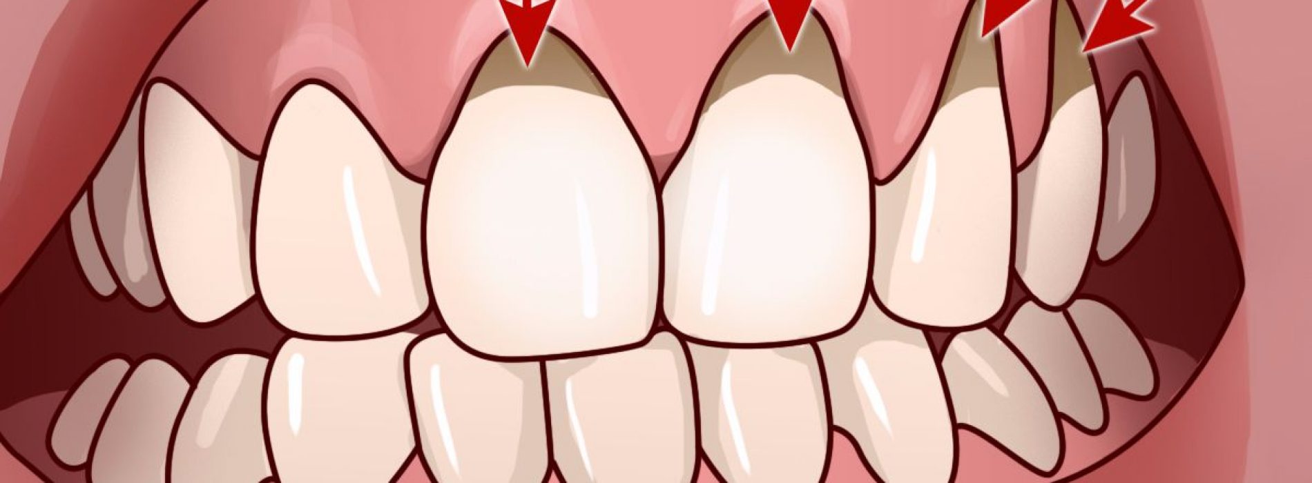 10 eenvoudige huismiddeltjes om tandvleesontsteking te helpen verlichten