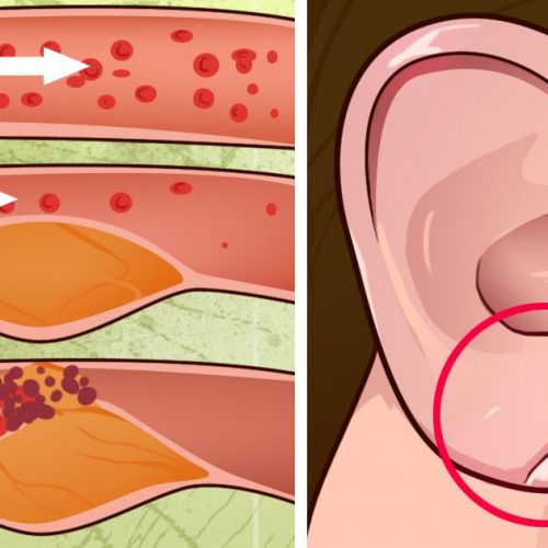 9 tekens die een waarschuwing zijn die aangeeft dat de bloedvaten verstopt zitten