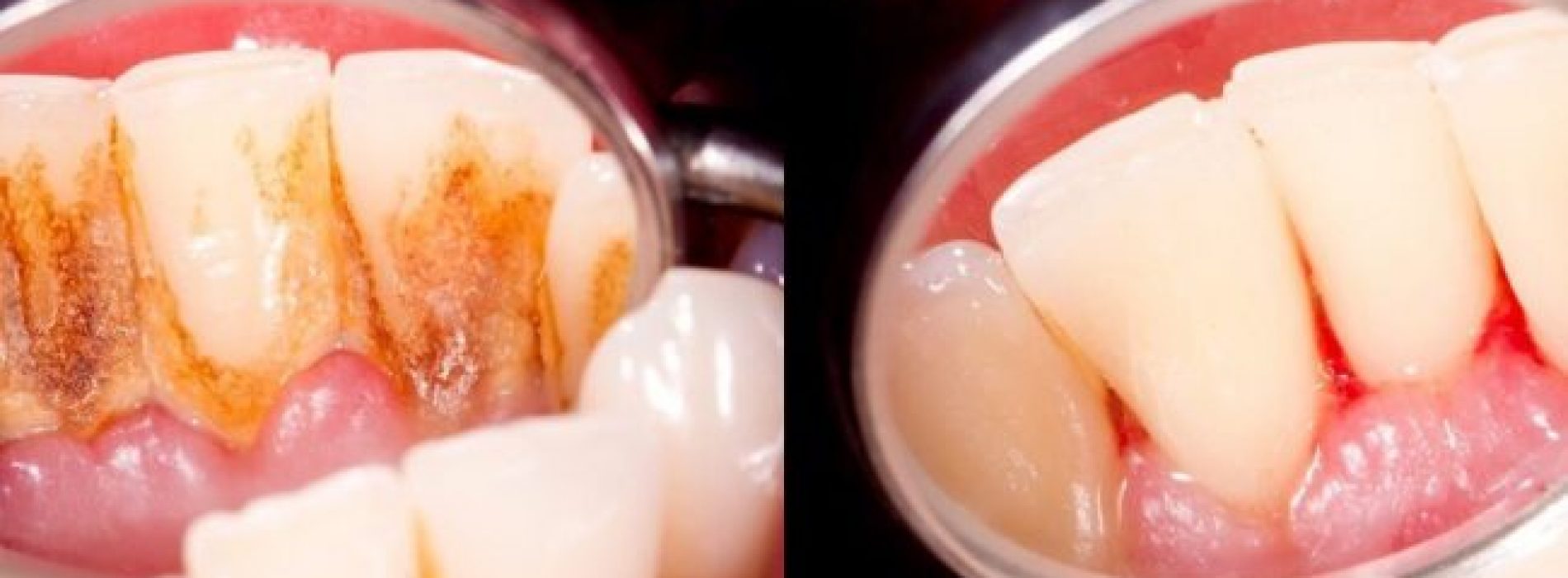 4 mengsels die tandplak volledig van uw tanden verwijderen