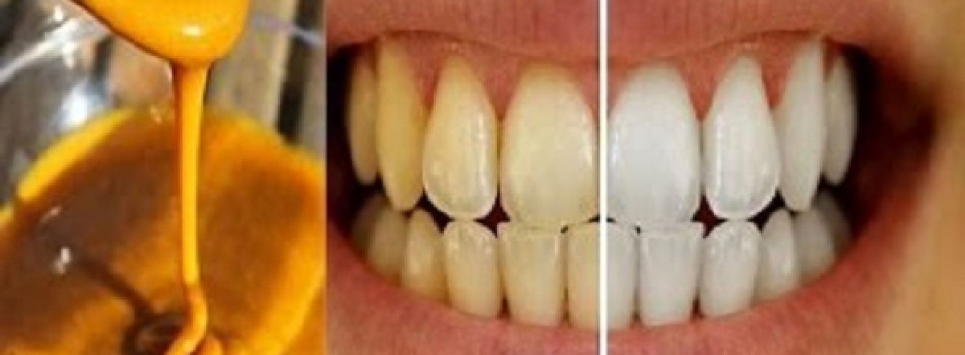 Deze zelfgemaakte tandpasta draait tandvleesaandoeningen terug en maakt tanden witter!
