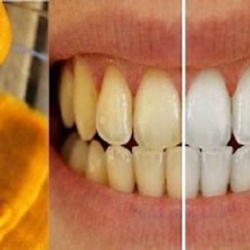 Deze zelfgemaakte tandpasta draait tandvleesaandoeningen terug en maakt tanden witter!