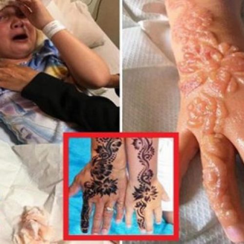 7-jarige meisje lijdt aan chemische brandwonden door tijdelijke tatoeages
