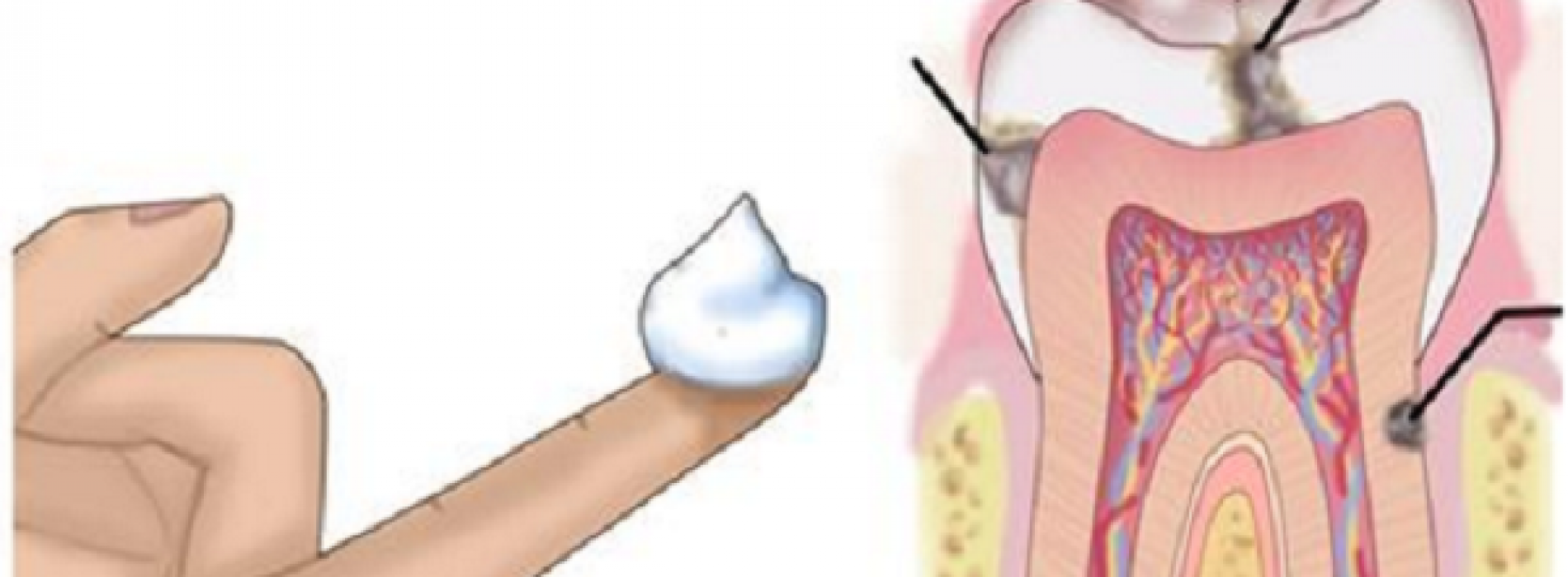 Waarom een tandarts kokosolie gebruikt om gaatjes te bestrijden en hoe je het thuis kunt doen