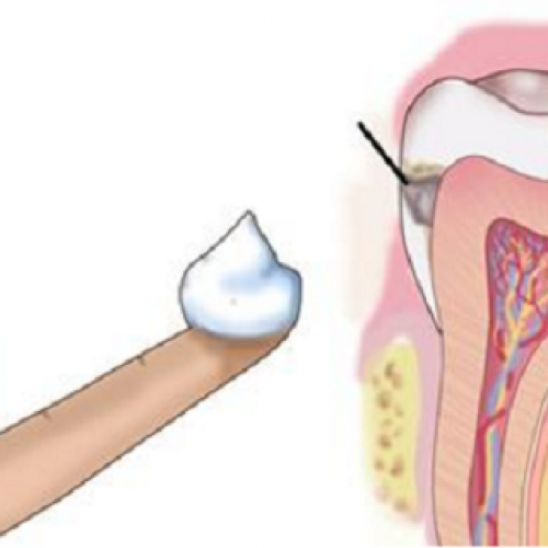 Waarom een tandarts kokosolie gebruikt om gaatjes te bestrijden en hoe je het thuis kunt doen