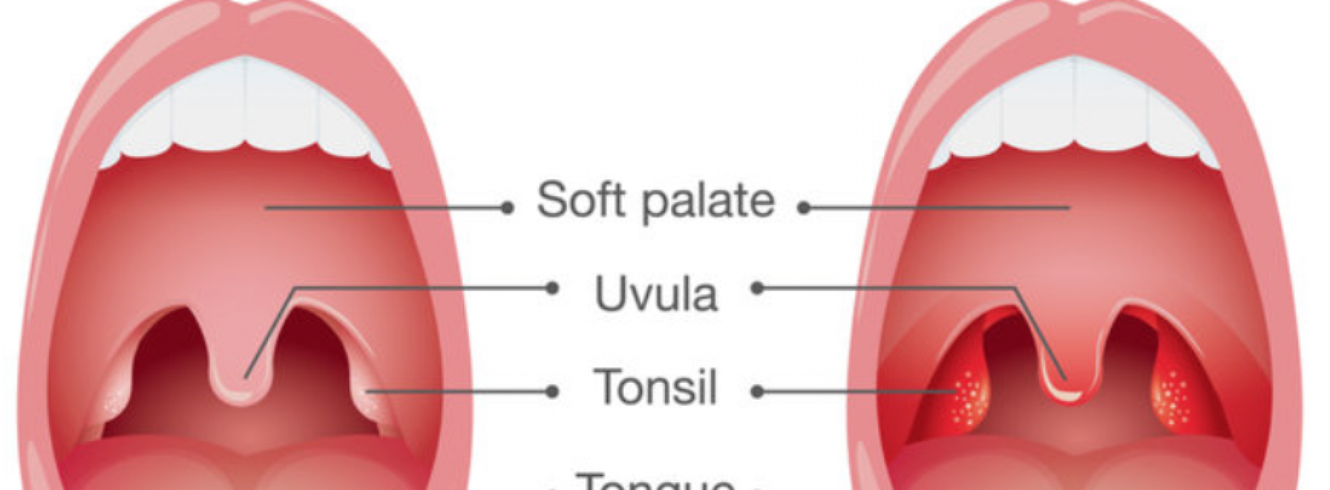 10 eenvoudige maar effectieve huismiddeltjes voor tonsillitis