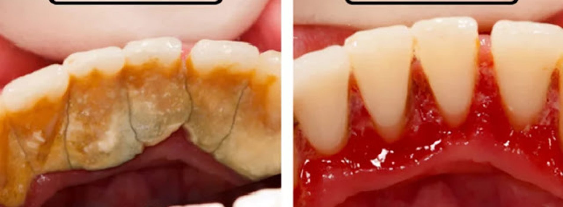 4 mengsels die tandplak volledig van uw tanden verwijderen