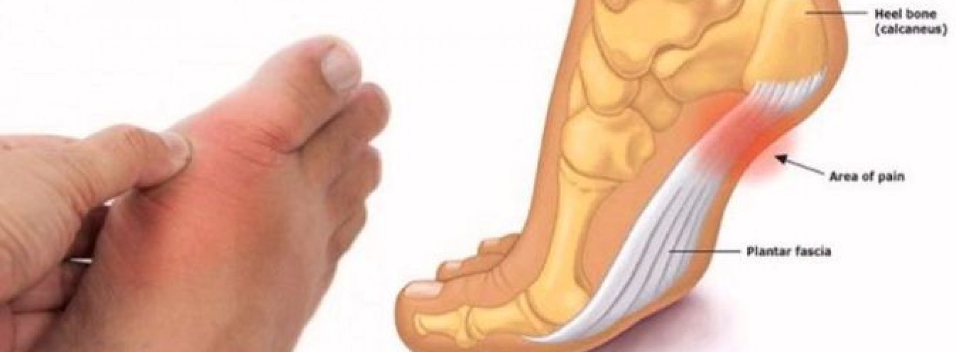 Controleer je voeten en kijk wat ze je vertellen over je bloeddruk, schildklier- en artritis risico