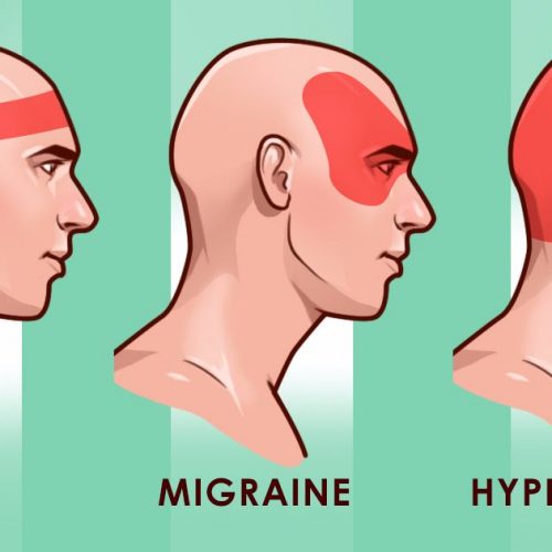 Stop hoofdpijn zonder pillen