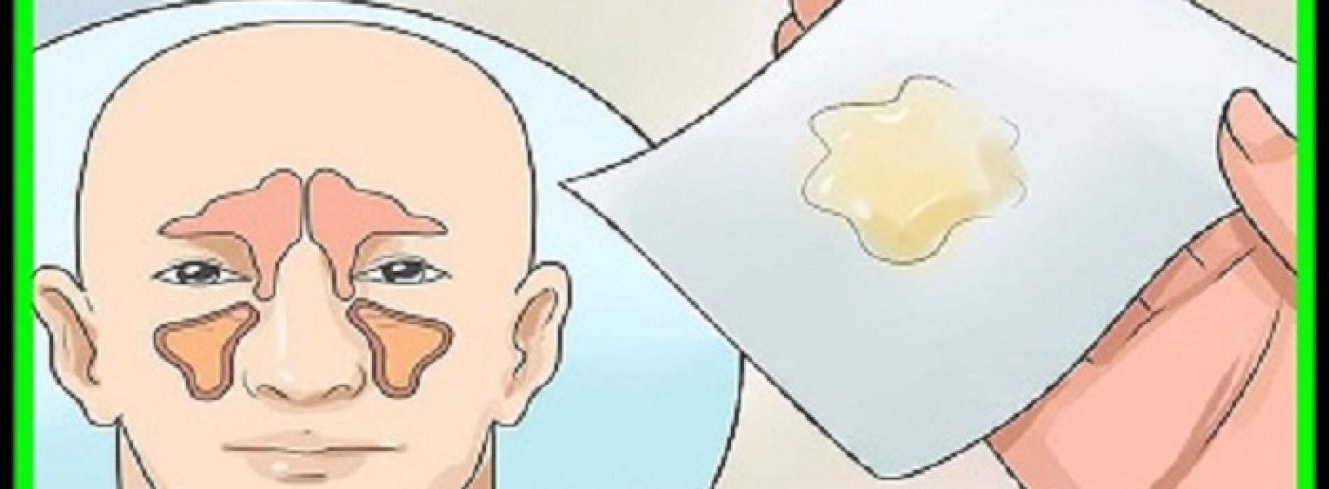 Hoe je afkomt van de hypofyse (slijm) en slijm in de borst en keel!