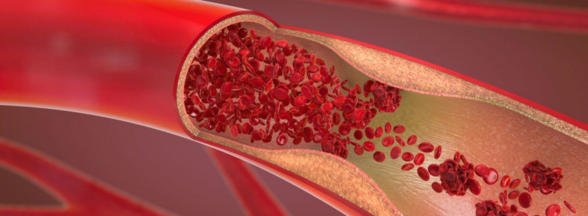 8 manieren om cholesterol en hoge bloeddruk te bestrijden